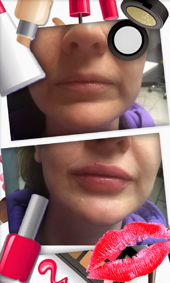 Juvederm lip treatment in The Woodlands, TX - Before and After Photo #2