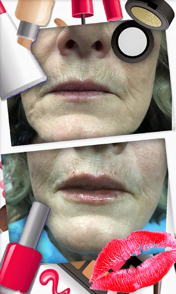 Juvederm lip treatment in The Woodlands, TX - Before and After Photo #3
