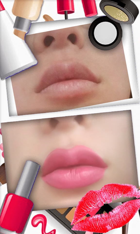 Juvederm lip treatment in The Woodlands, TX - Before and After Photo #4