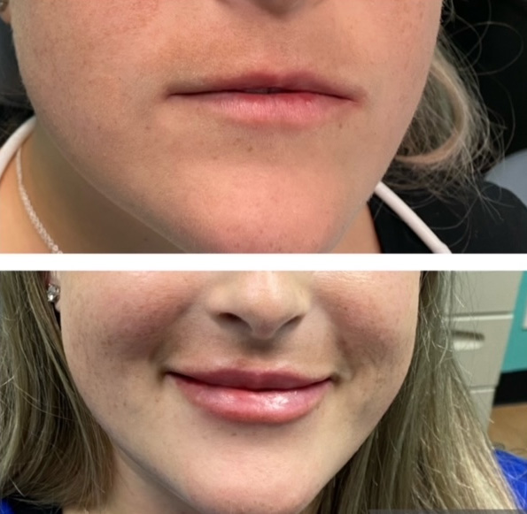 Juvederm lip treatment in The Woodlands, TX - Before and After Photo #1